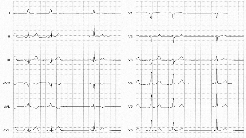 Wolff-Parkinson-White (WPW) 12 Lead EKG